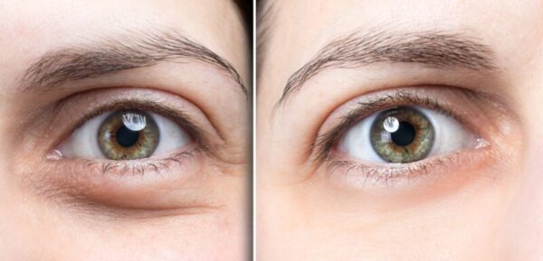 poches sous les yeux