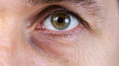 veines sous les yeux